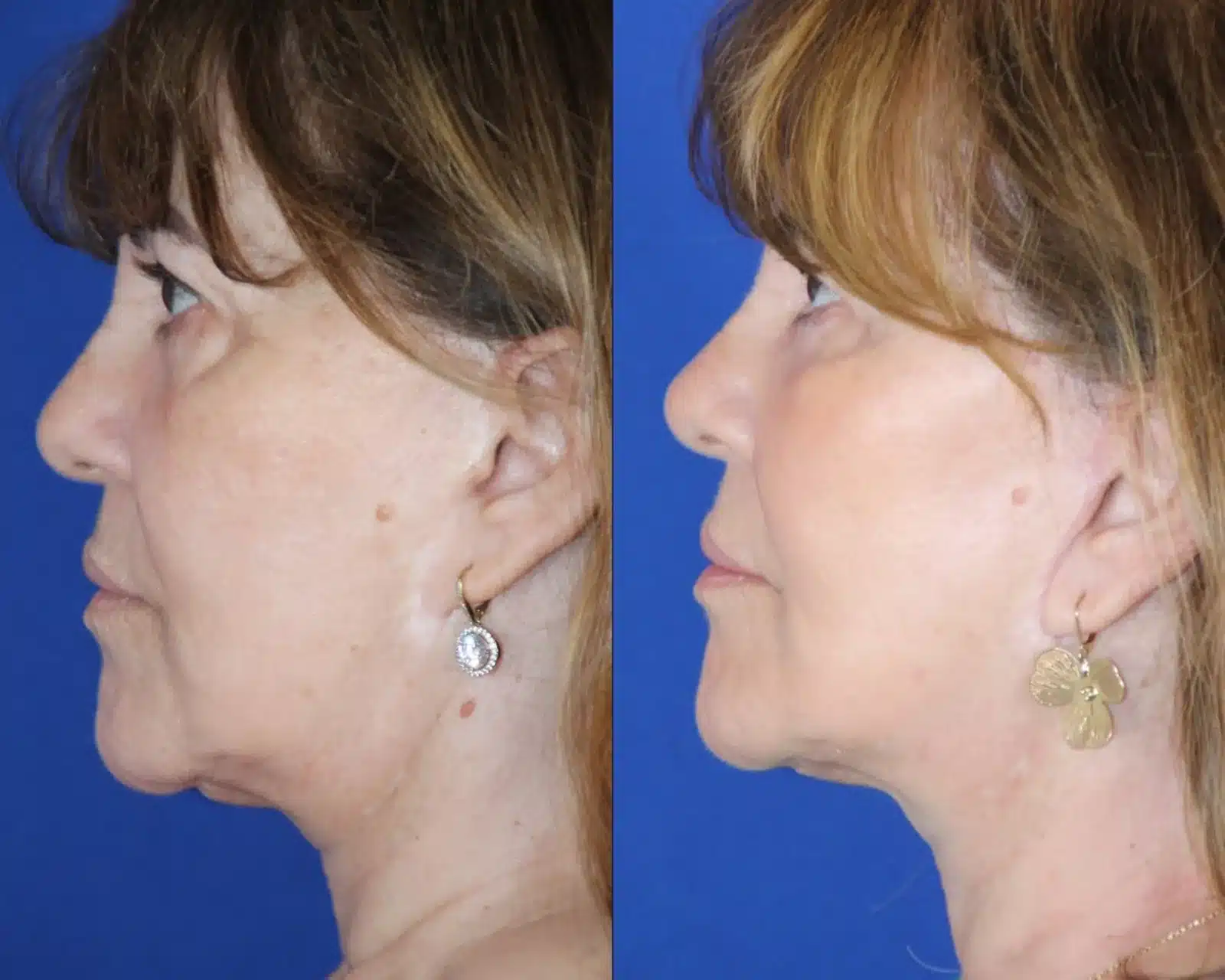 Facelift before & after, right profile &mdash; Patient 5 &mdash; Facelift & Neck Lift