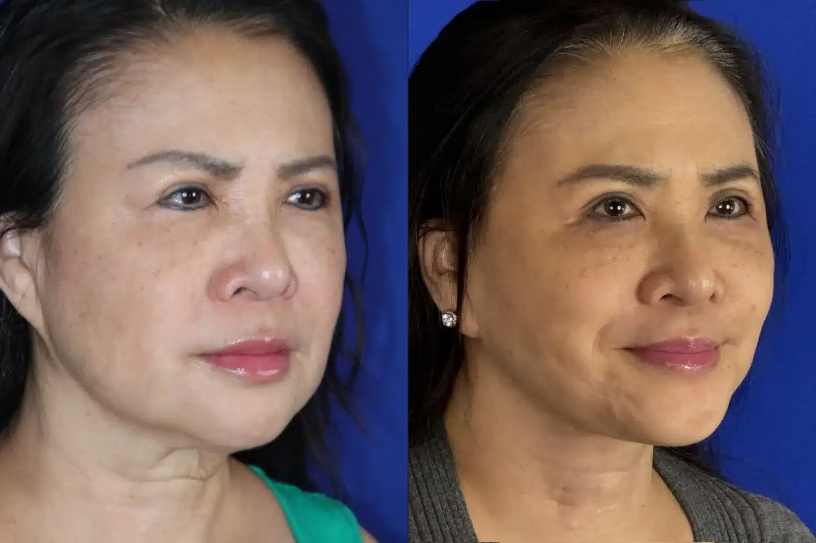 Facelift before & after, three-quarter view &mdash; Patient 6 &mdash; Facelift Results