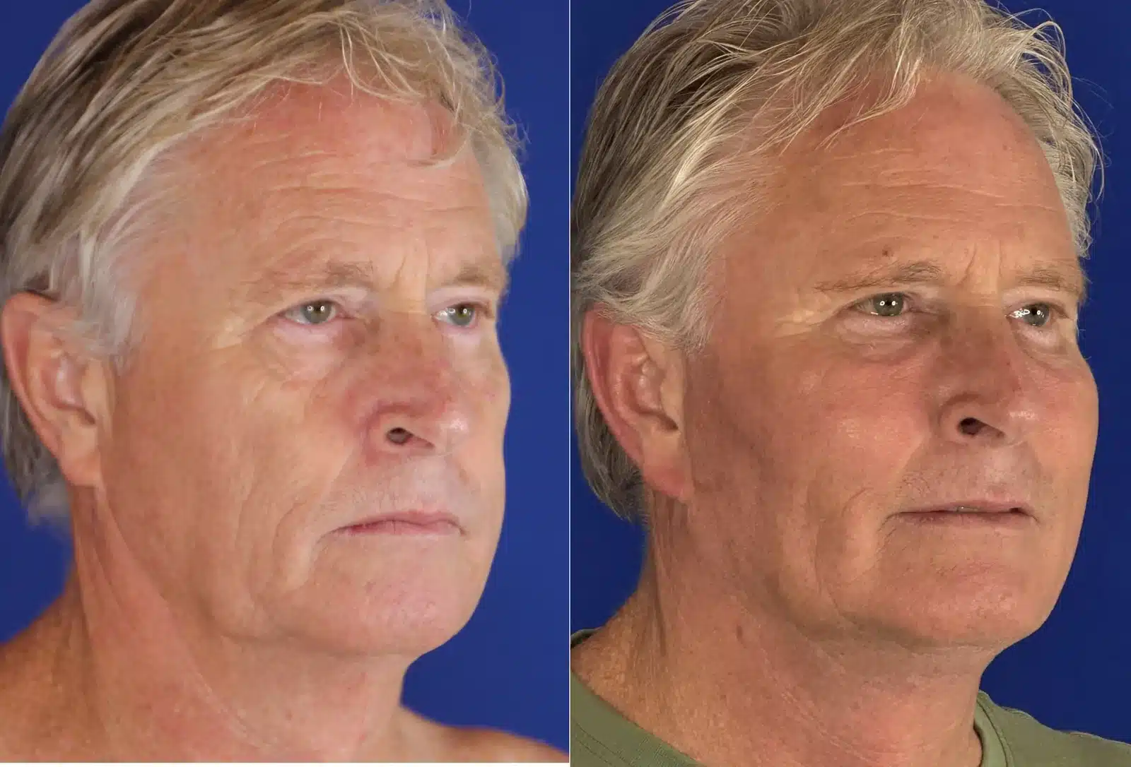 Facelift before & after, three-quarter view &mdash; Patient 4 &mdash; Facelift & Neck Lift