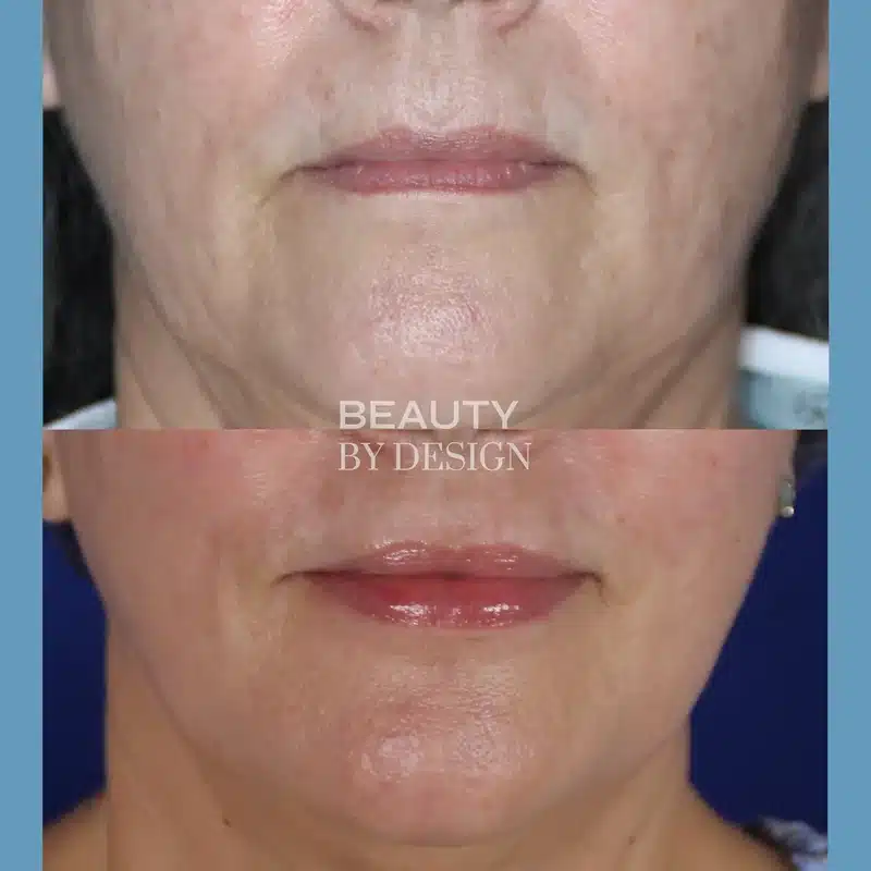 Lip filler before and after &mdash; close-up of chin and lip area, female patient