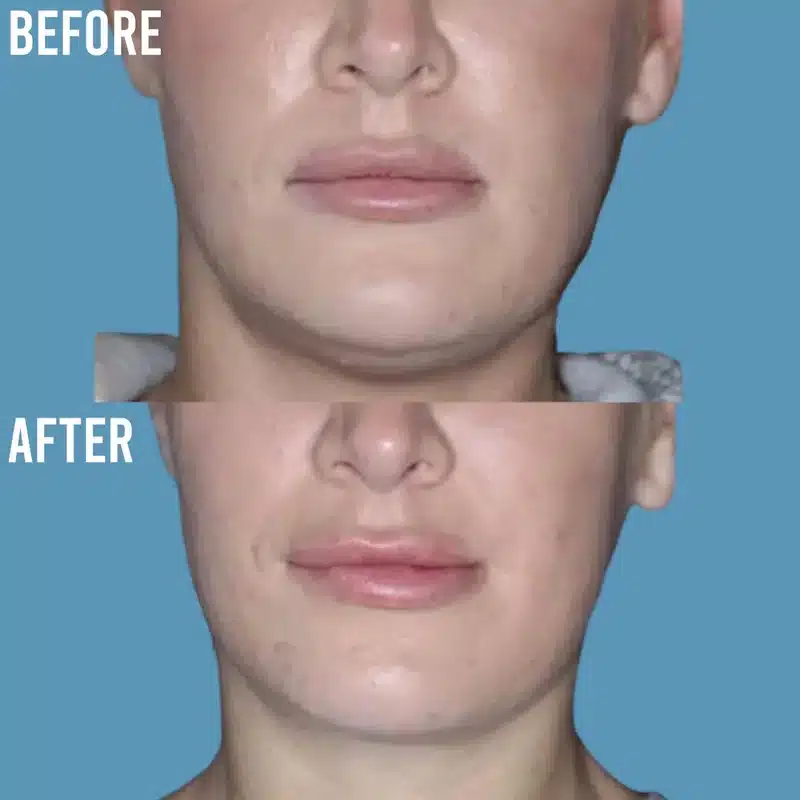 Lip filler before and after &mdash; frontal view, lip enhancement results