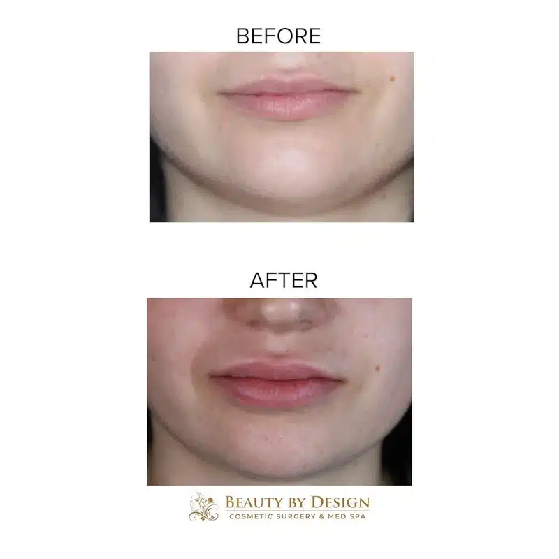 Lip filler before and after &mdash; frontal view, young female patient, Dr. Troell