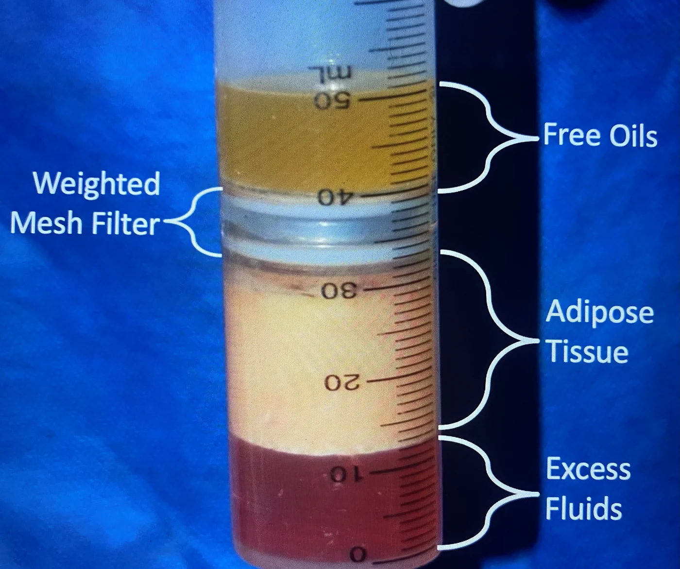 MediKan TP-101 centrifugation-filtration syringe showing harvested fat separated into free oils, a weighted mesh filter, purified adipose tissue, and excess fluids &mdash; the fat-purification step in Dr. Robert J. Troell's J Clin Med 2025 protocol.