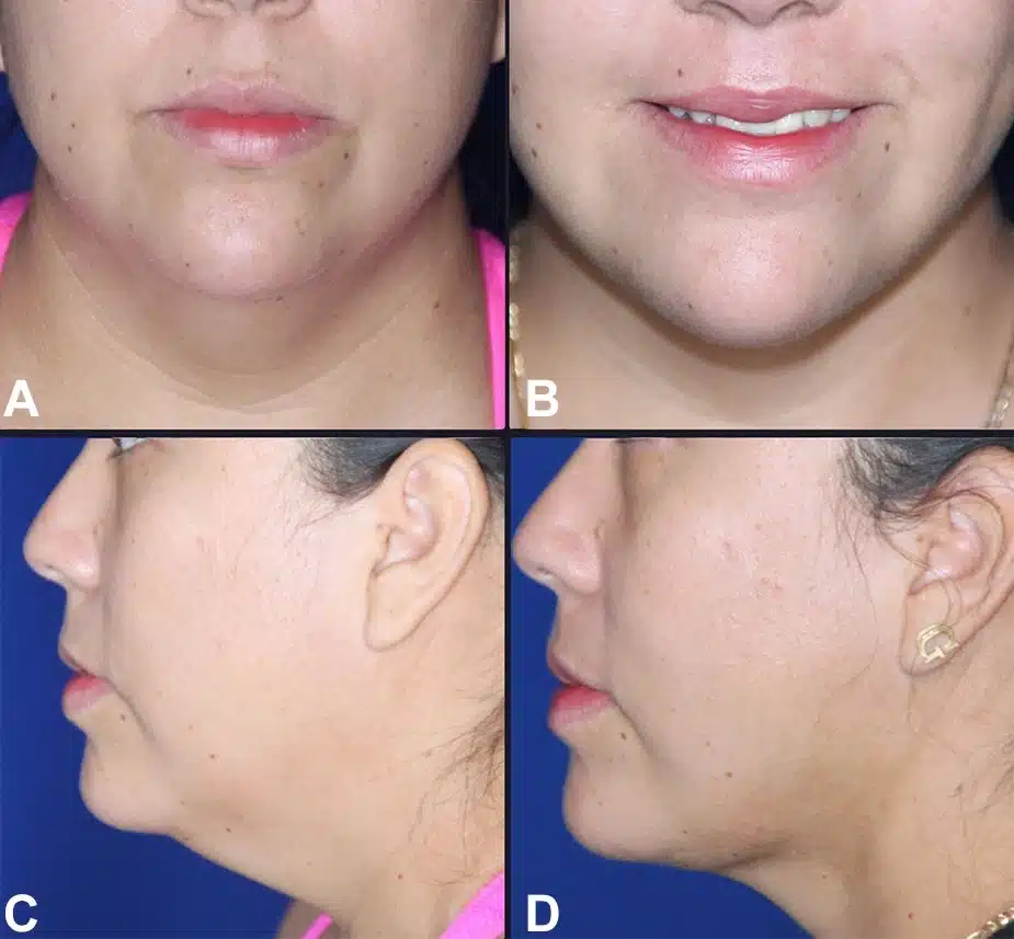 Figure 1 from Troell+Javaheri 2025 AJCS &mdash; A 32-year-old woman before and three months after VASER ultrasound liposuction with Renuvion helium-plasma skin tightening of the lower face and neck; approximately 100 cc of fat removed.