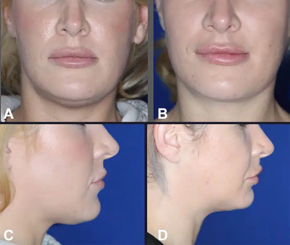Figure 2 from Troell+Javaheri 2025 AJCS &mdash; A 38-year-old woman before and after VASER ultrasound liposuction with Renuvion helium-plasma skin tightening of the jowls and neck; approximately 50 cc of fat removed.