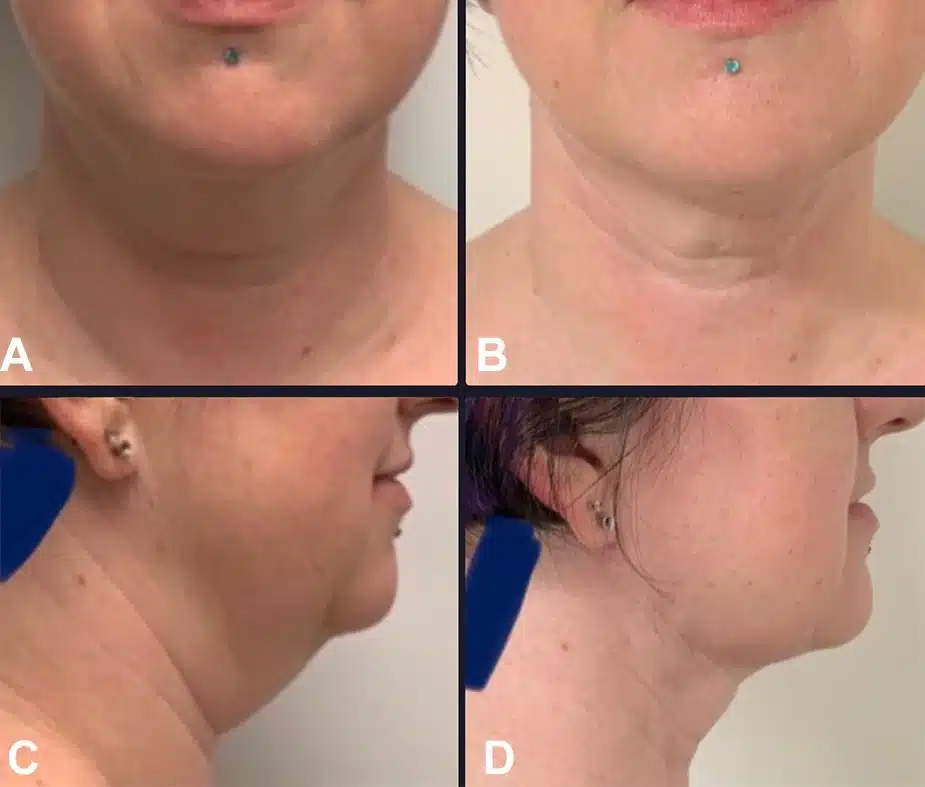 Figure 3 from Troell+Javaheri 2025 AJCS &mdash; A 40-year-old woman before and four months after VASER ultrasound liposuction with Renuvion helium-plasma skin tightening of the face and neck; approximately 125 cc of fat removed.