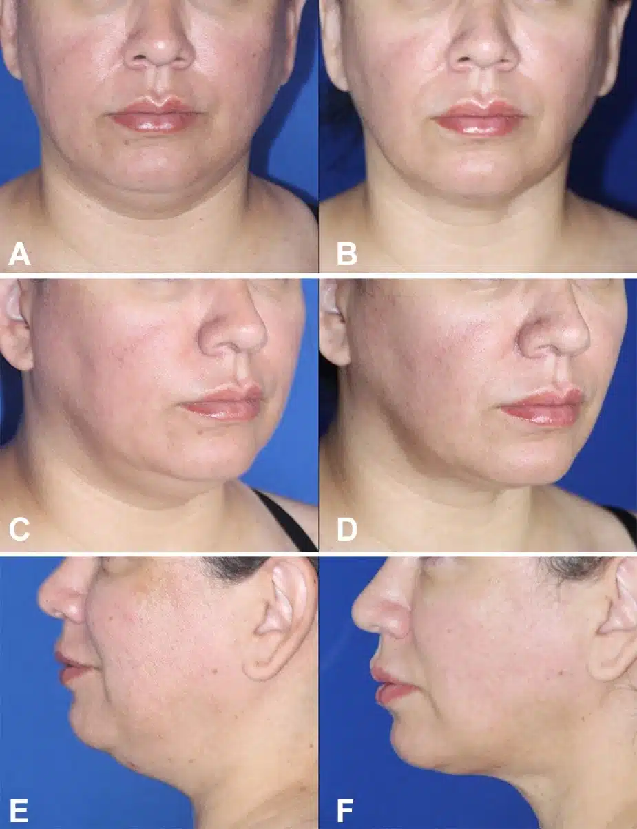 Figure 4 from Troell+Javaheri 2025 AJCS &mdash; A 46-year-old woman, 4 feet 11 inches, 141 pounds, before and after VASER ultrasound liposuction with Renuvion helium-plasma skin tightening of the face and neck; approximately 125 cc of fat removed, six panels showing frontal, oblique, and profile views.