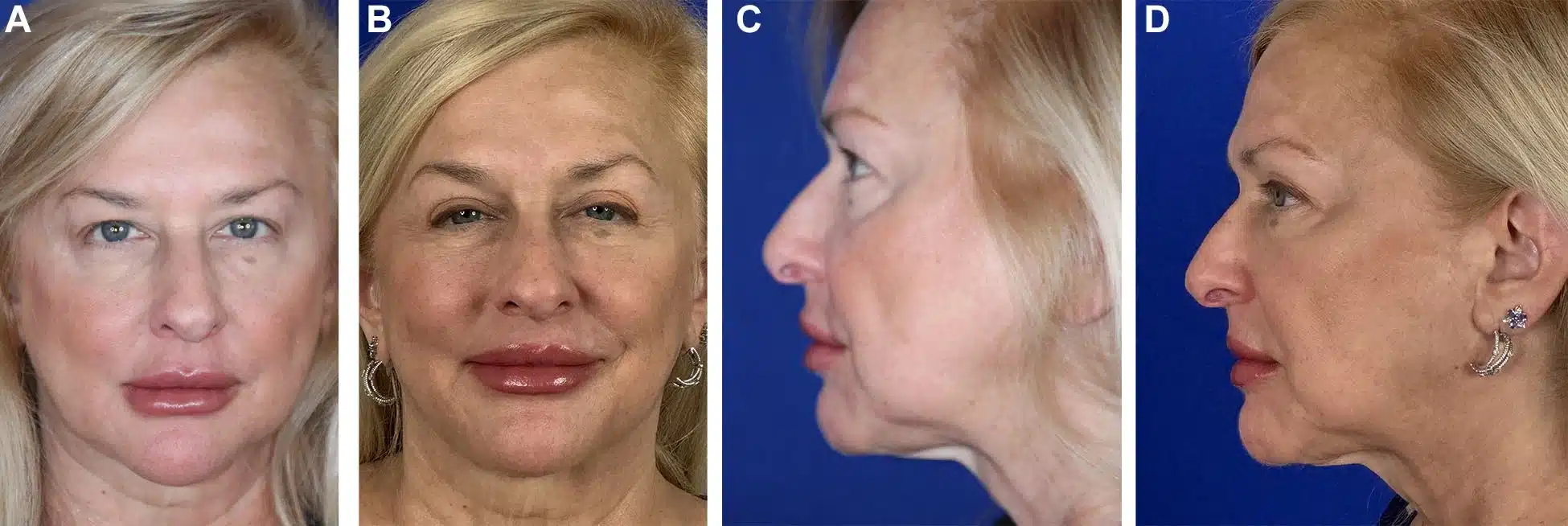 Figure 5 from Troell+Javaheri 2025 AJCS &mdash; A 59-year-old woman, 5 feet 1 inch, 130 pounds, who underwent upper blepharoplasty, midfacelift, VASER ultrasound liposuction, and Renuvion helium-plasma skin tightening of the jowls only; approximately 75 cc of fat removed.