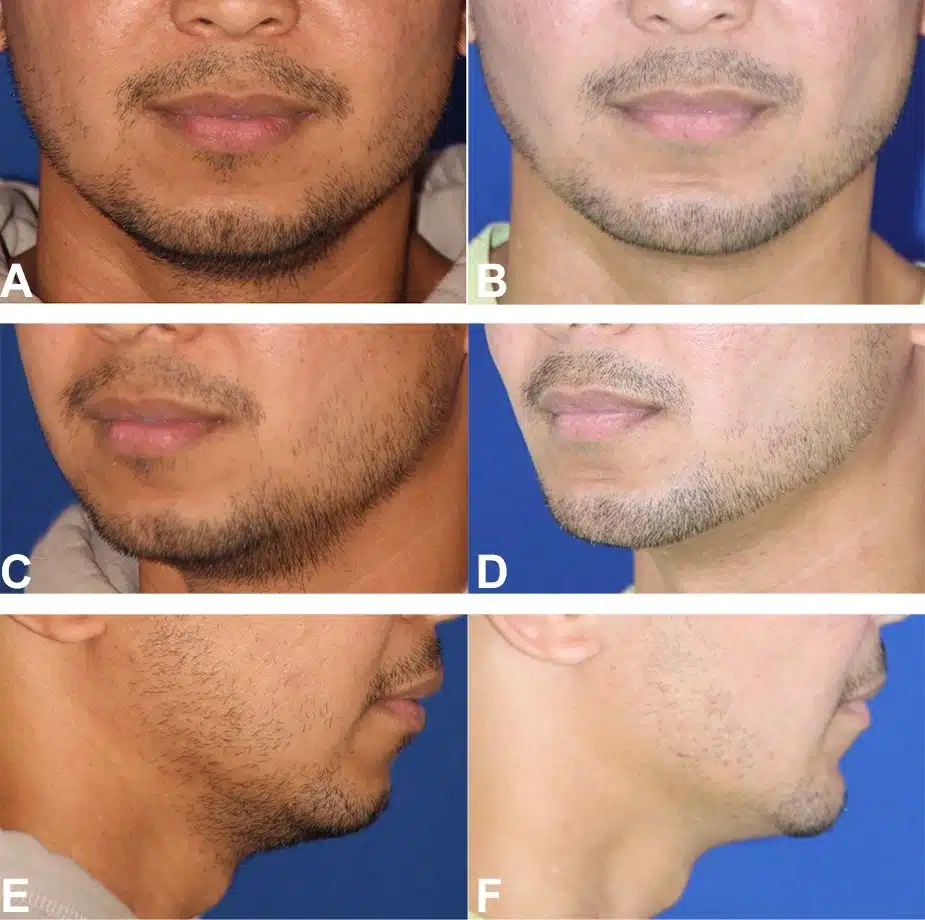 Figure 6 from Troell+Javaheri 2025 AJCS &mdash; A 37-year-old man, 5 feet 11 inches, 185 pounds, before and after VASER ultrasound liposuction with Renuvion helium-plasma skin tightening of the face and neck combined with a silicone chin implant; approximately 35 cc of fat removed, six panels.