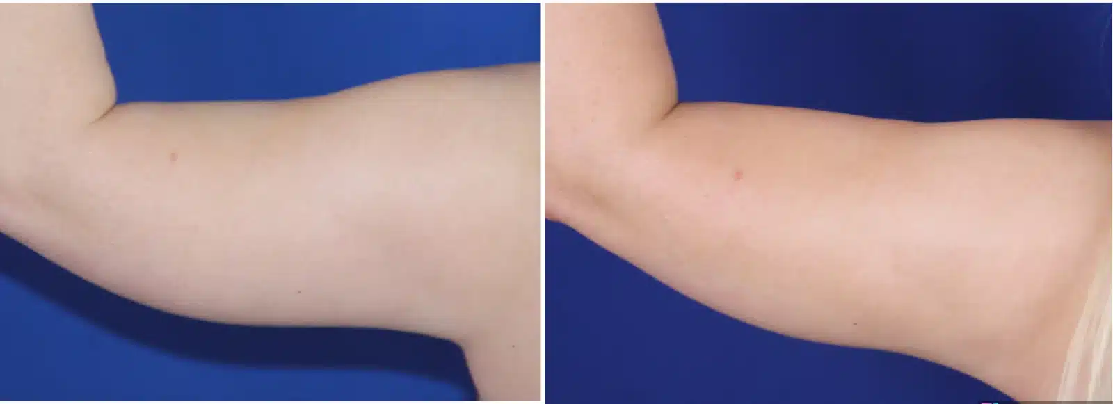 Arm liposuction before & after &mdash; Patient 1