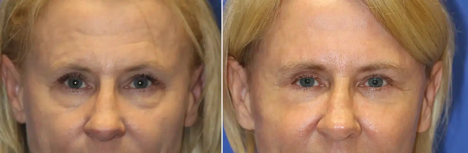Before-and-after of a patient with medial brow drooping after a medial Bellafill Browlift with lower eyelid surgery