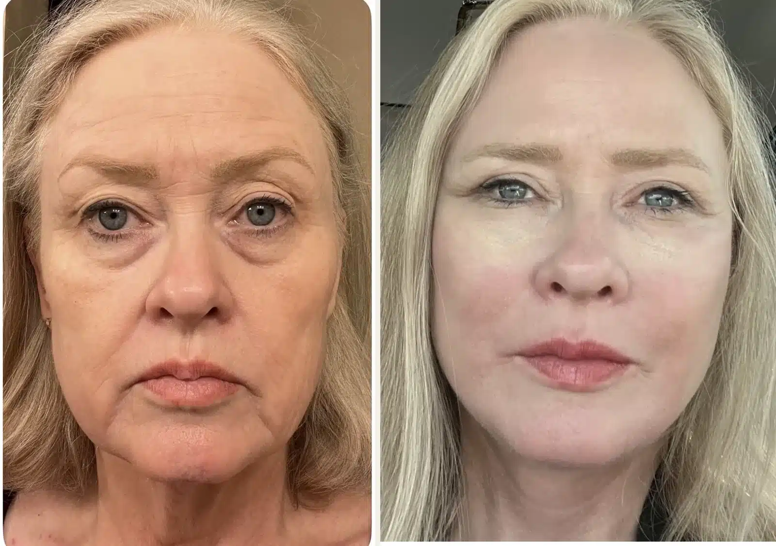 Before-and-after photographs of a patient with medial brow drooping after a Bellafill Browlift combined with eyelid surgery