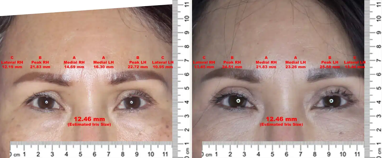 Before-and-after of a Bellafill Browlift with brow-height measurements in millimeters showing the medial and lateral elevation