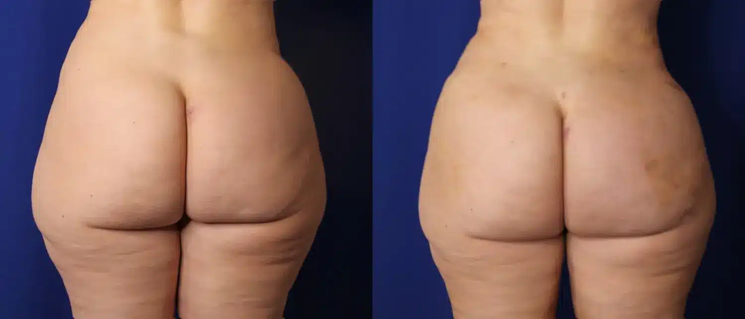 Before and after rear view of buttock fat grafting, showing increased upper-pole fullness, more projection, and a smoother, rounder contour with softened hip dips