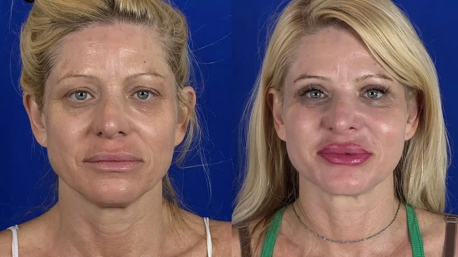Cheek implants before & after, front view &mdash; Patient 8 &mdash; Cheek Implants