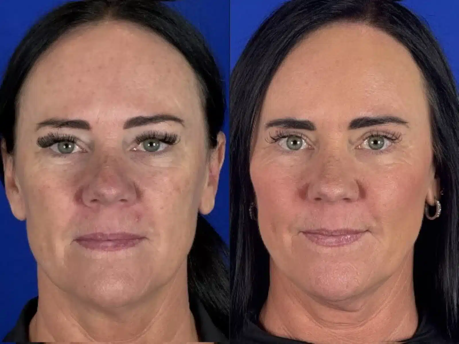 Cheek implants before & after, front view &mdash; Patient 6