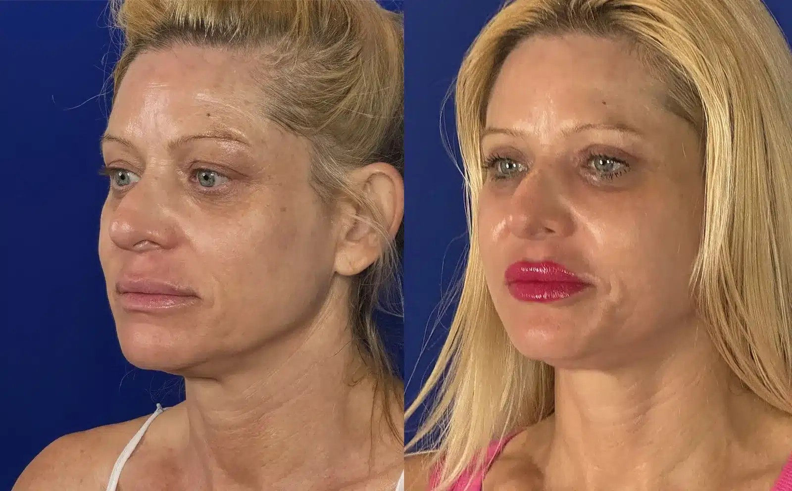 Cheek implants before & after, oblique view &mdash; Patient 8 &mdash; Cheek Implants