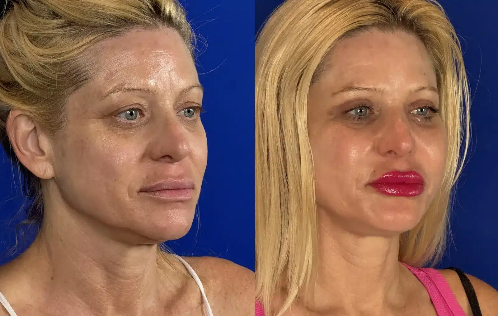 Cheek implants before & after, three-quarter view &mdash; Patient 8 &mdash; Cheek Implants