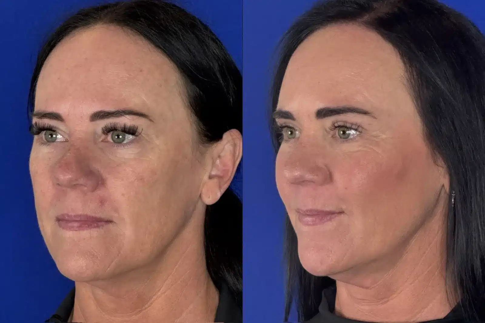 Cheek implants before & after, three-quarter view &mdash; Patient 6