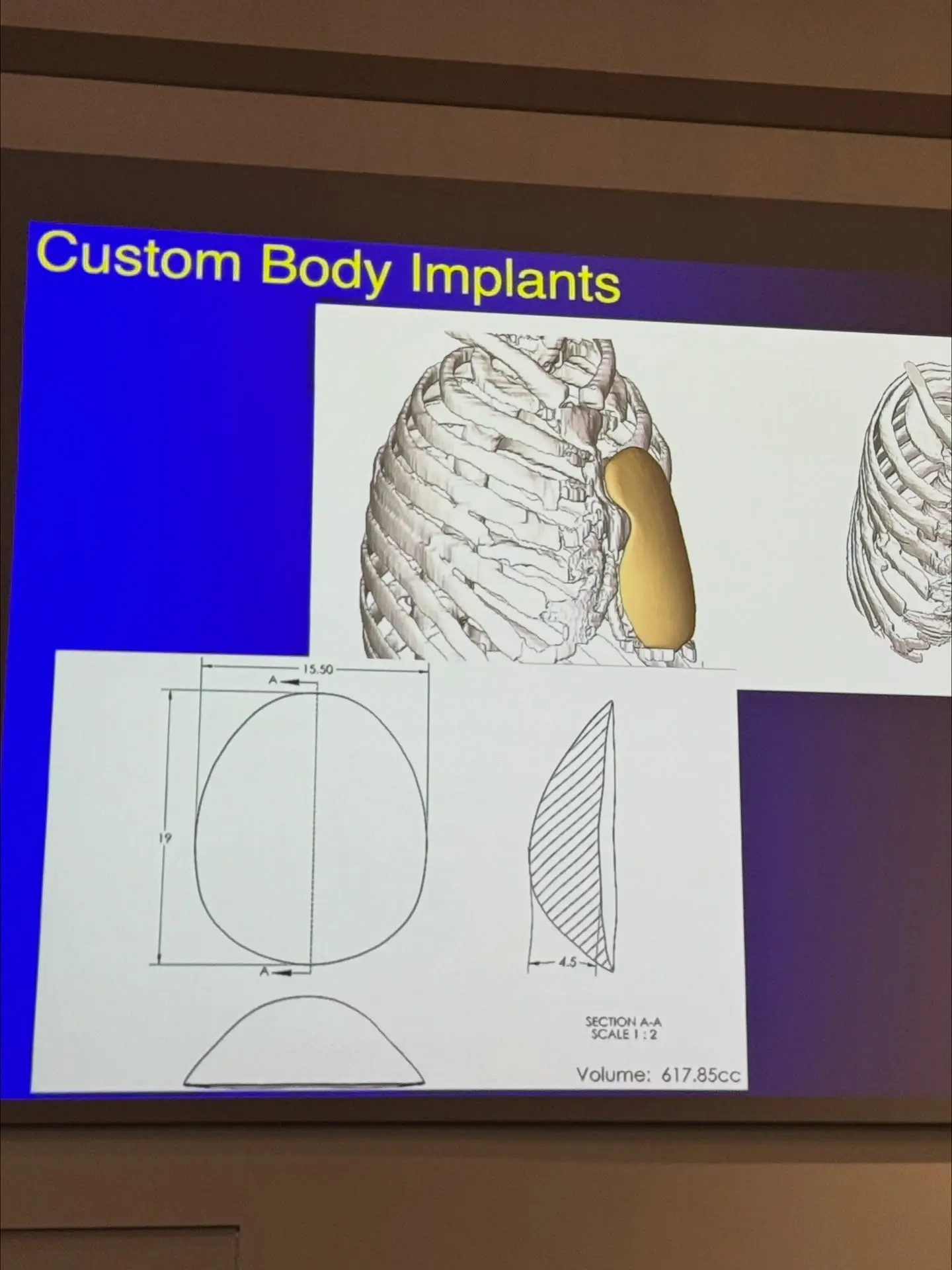 Custom hip and body implant design sketches from Dr. Troell's implant work
