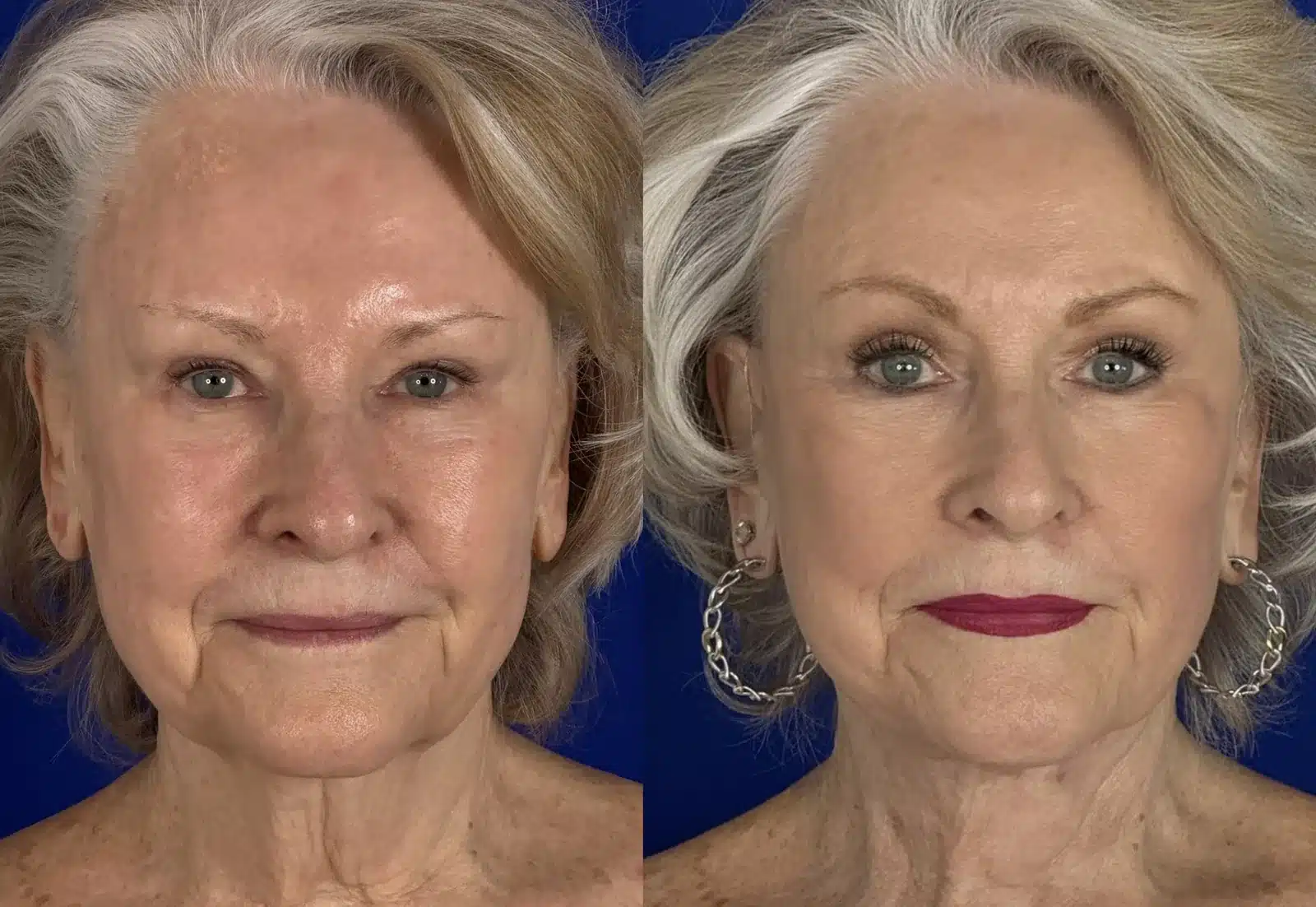 Facelift with upper blepharoplasty before & after, front view &mdash; Patient 9 &mdash; Facelift