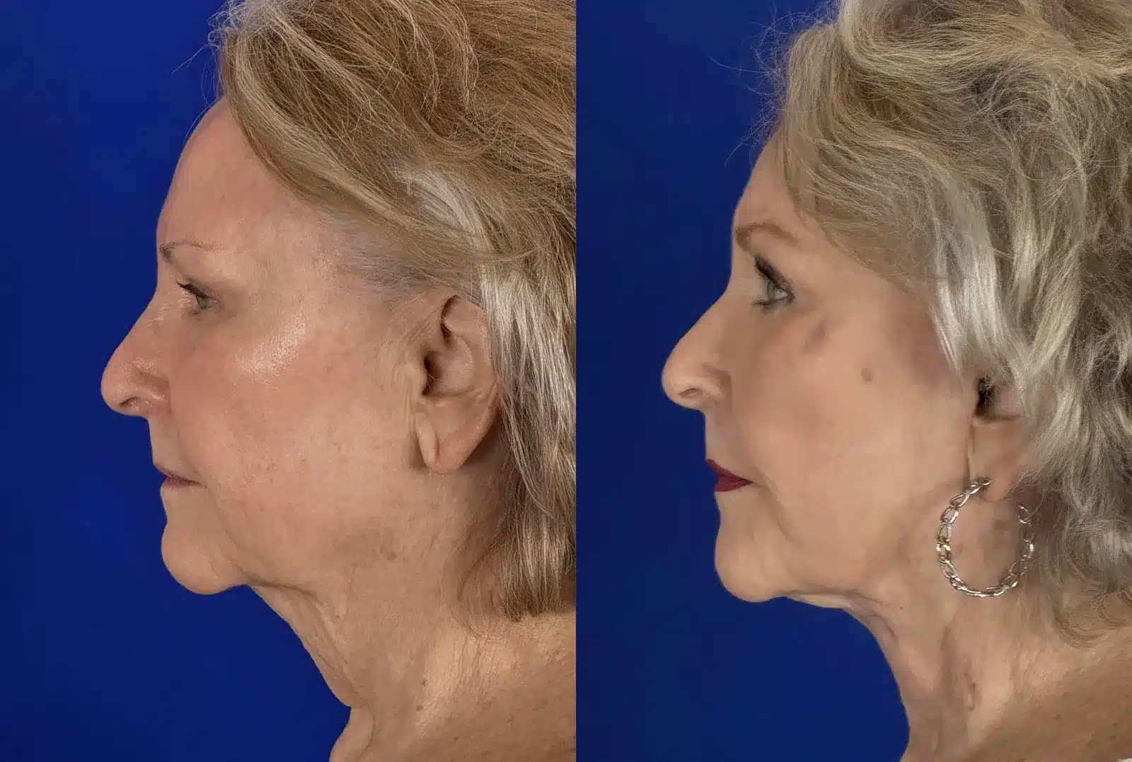 Facelift with upper blepharoplasty before & after, right profile &mdash; Patient 9 &mdash; Facelift