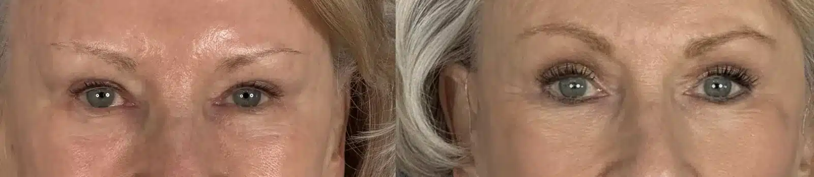 Upper blepharoplasty eyelid detail before & after, front view &mdash; Patient 9 &mdash; Facelift