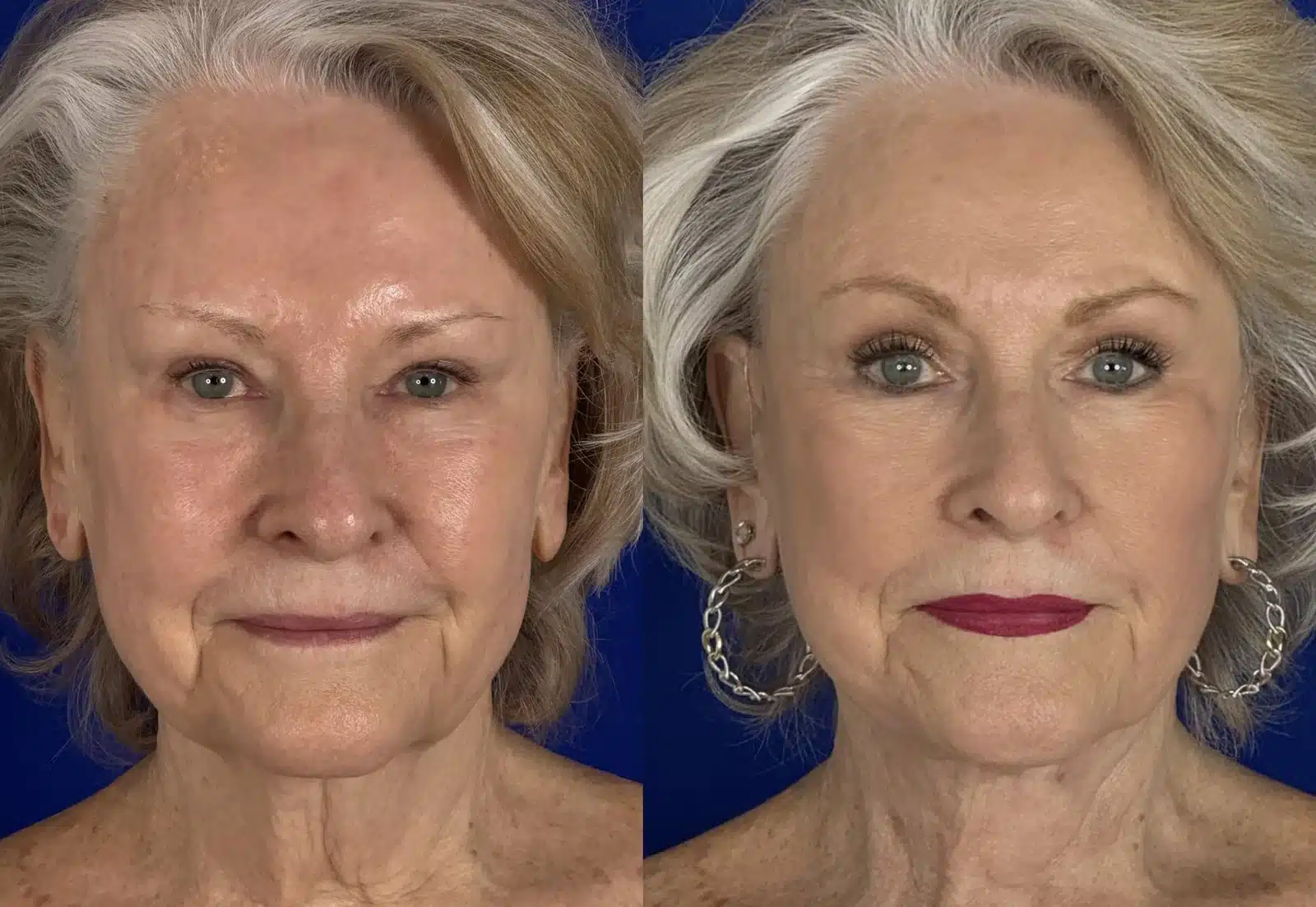 Facelift and cheek implant before & after, front view &mdash; Patient 8 &mdash; Facelift & Cheek Implants
