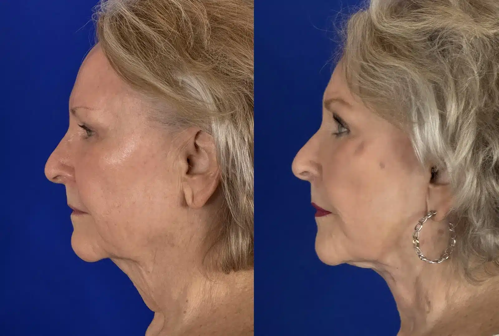 Facelift and cheek implant before & after, left profile &mdash; Patient 8 &mdash; Facelift & Cheek Implants