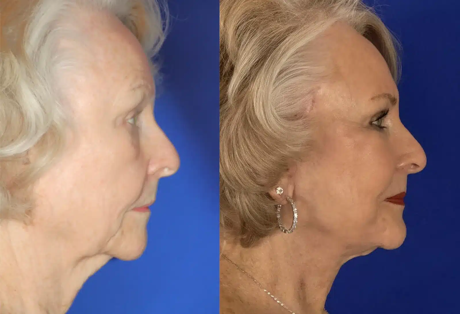 Facelift and cheek implant before & after, right profile &mdash; Patient 8 &mdash; Facelift & Cheek Implants