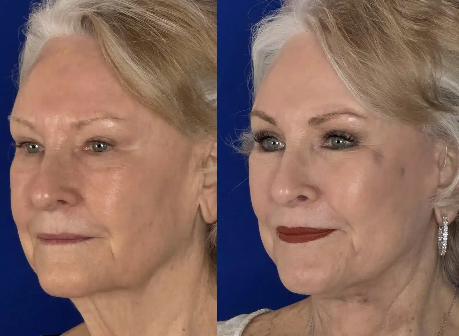 Facelift and cheek implant before & after, three-quarter view &mdash; Patient 8 &mdash; Facelift & Cheek Implants
