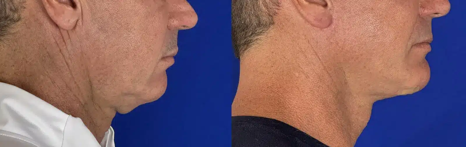 Jowl liposuction before & after, right profile &mdash; Patient 9 &mdash; Jowl Liposuction