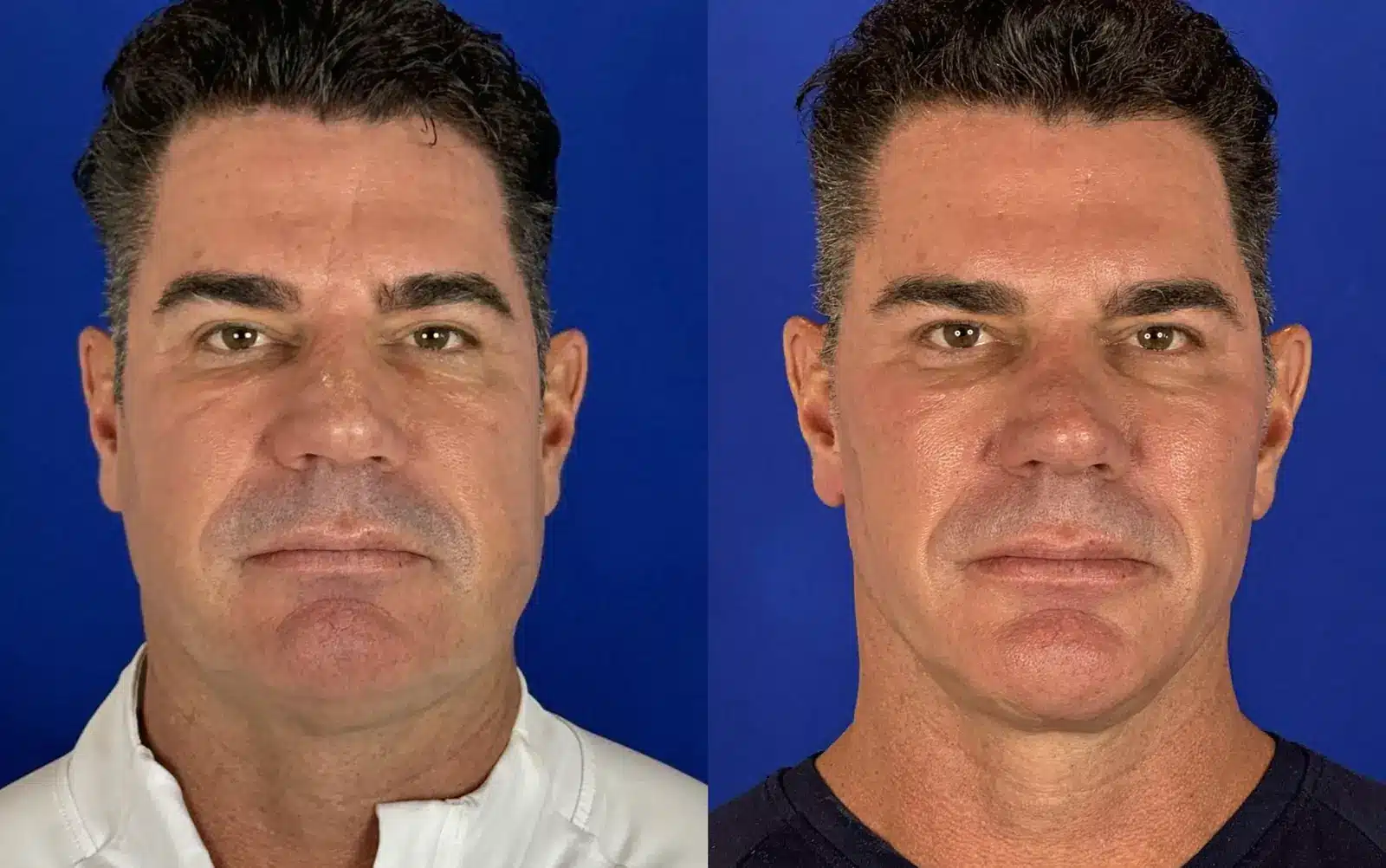 Male facelift before and after, frontal view &mdash; a tighter jawline and smoother neck after repositioning descended tissue