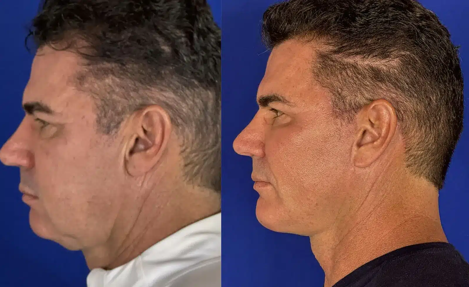 Male facelift before and after, left profile &mdash; reduced jowl and submental fullness with a sharper jawline-to-neck angle