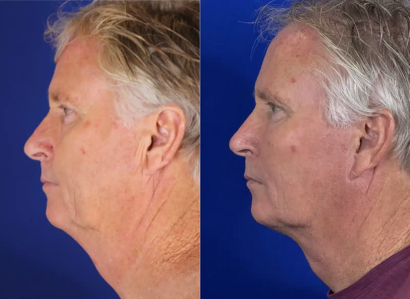 Facelift before & after, left profile view &mdash; Patient 4 &mdash; Facelift & Neck Lift