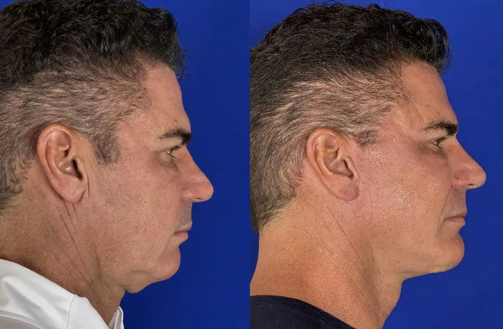 Facelift before & after, right profile &mdash; Patient 7 &mdash; Facelift