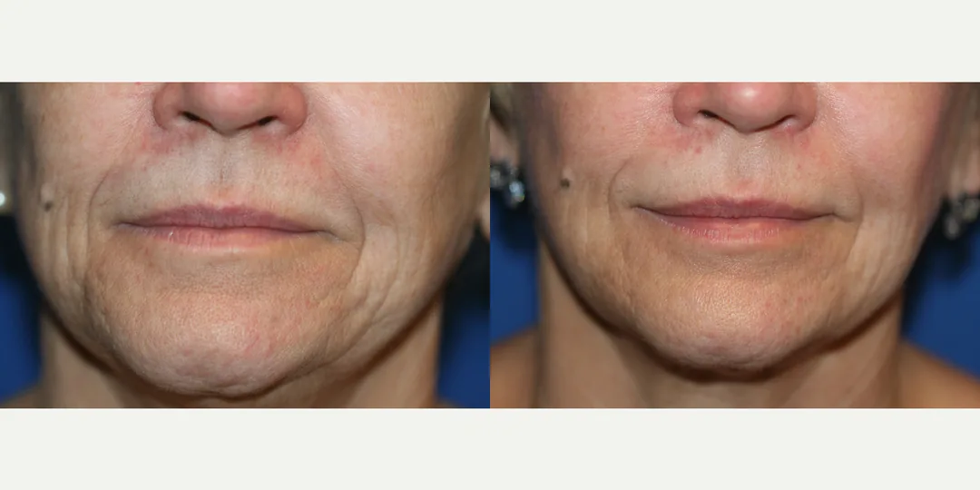 Before and after facial fat grafting by Dr. Robert J. Troell &mdash; a woman with mature skin whose deep nasolabial folds are softened and flattened lower cheeks refilled using her own purified fat