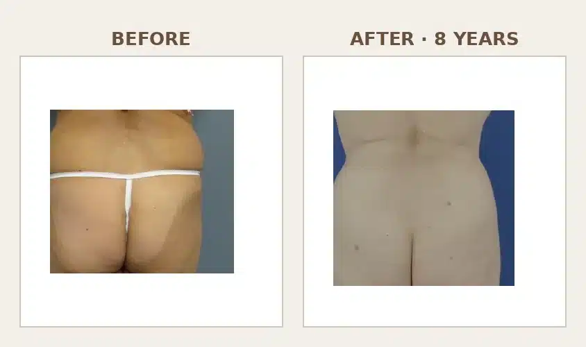 Before and after-at-8-years rear-view photographs of gluteal and hip fat grafting, showing a smoother, more contoured lower back, flanks, and buttock