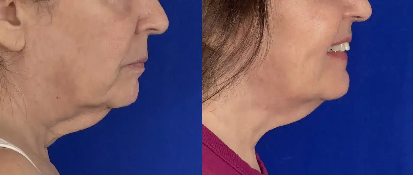 Jowl & neck liposuction before & after, jawline and neck close-up &mdash; Patient 8 &mdash; Jowl Liposuction