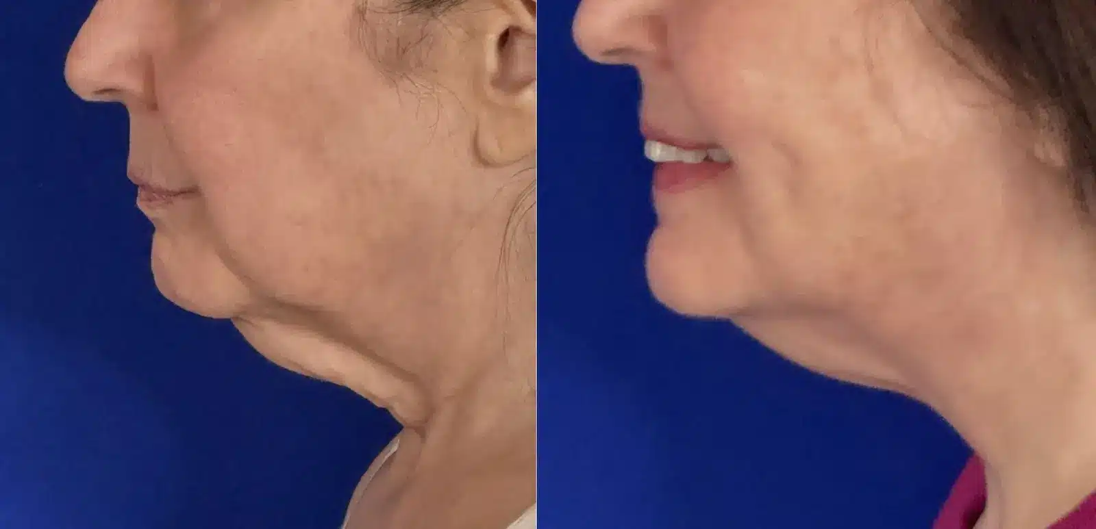 Jowl & neck liposuction before & after, jawline and neck close-up &mdash; Patient 8 &mdash; Jowl Liposuction