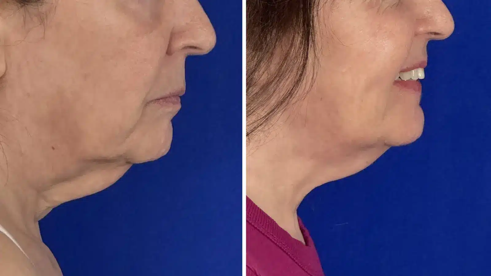 Jowl & neck liposuction before & after, left profile &mdash; Patient 8 &mdash; Jowl Liposuction