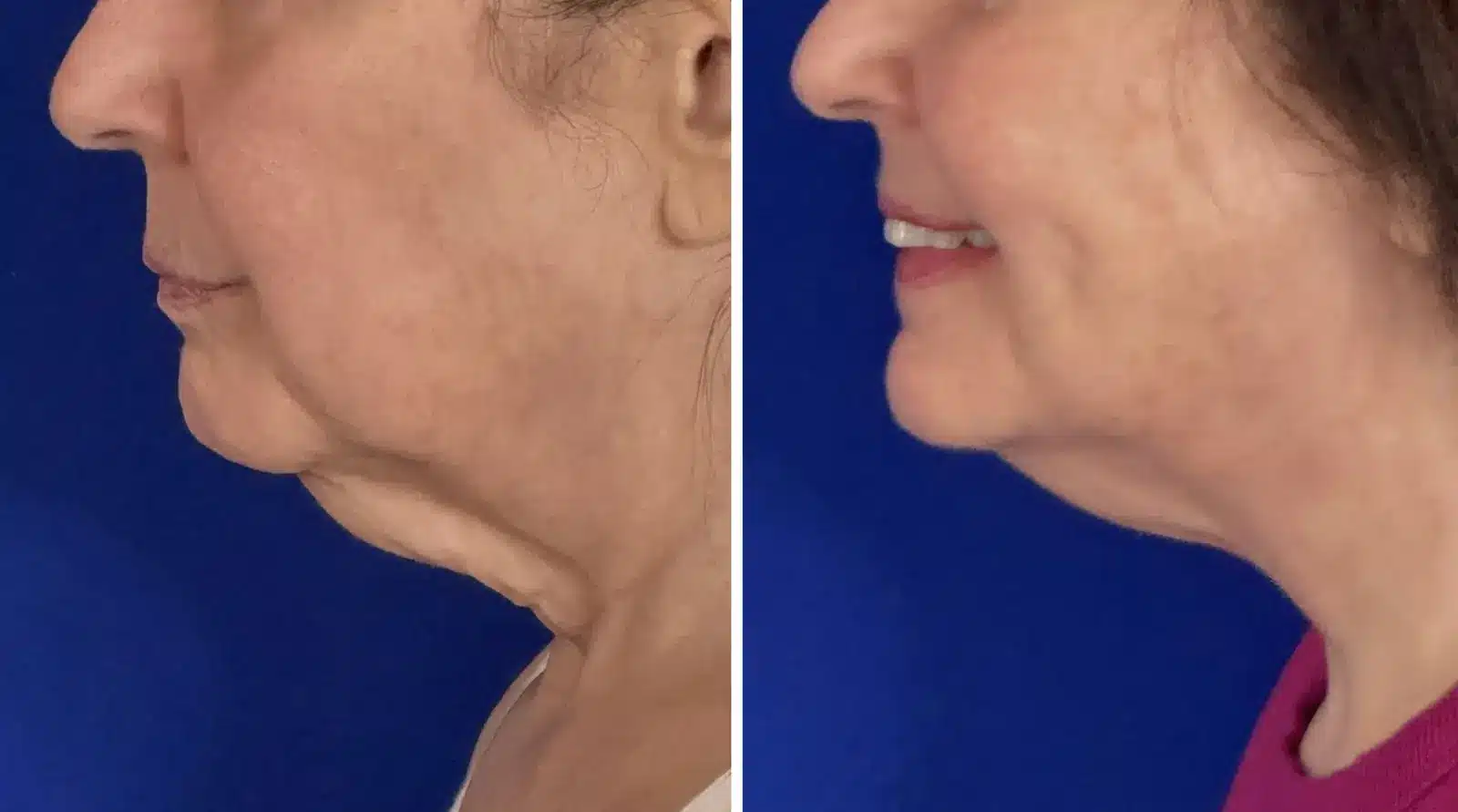 Jowl & neck liposuction before & after, left profile &mdash; Patient 8 &mdash; Jowl Liposuction