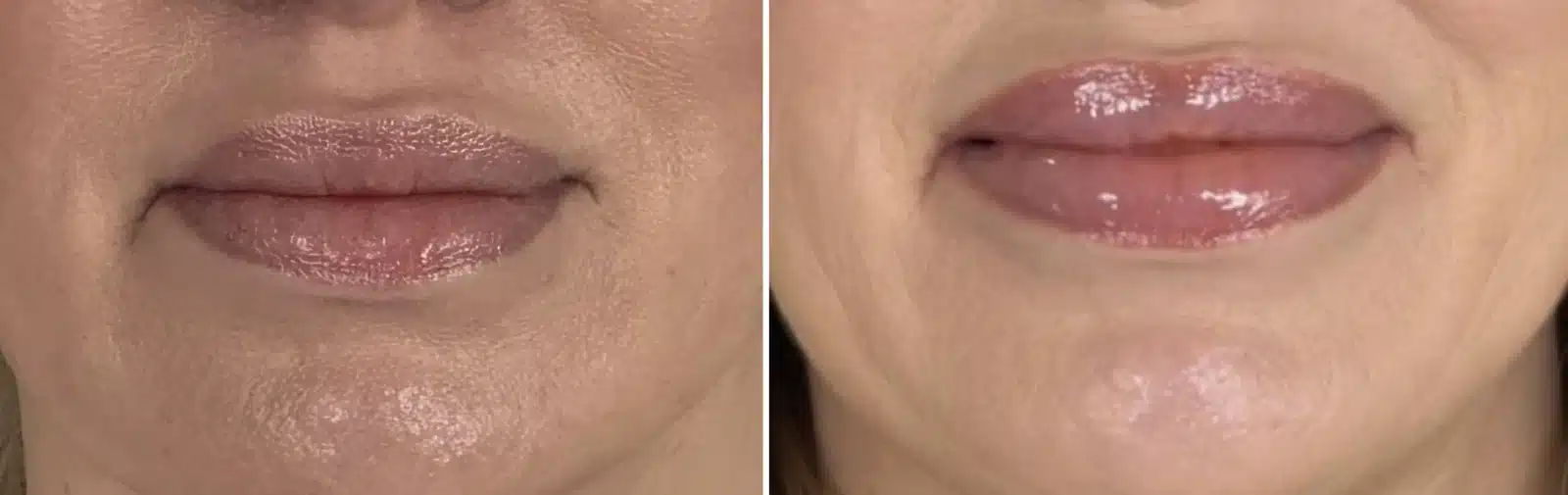 Lip filler before & after &mdash; Patient 8
