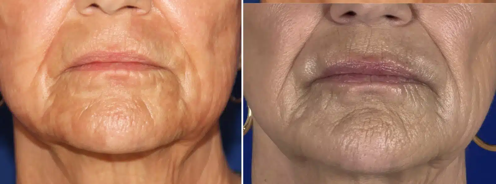 Lip filler before & after &mdash; Patient 7