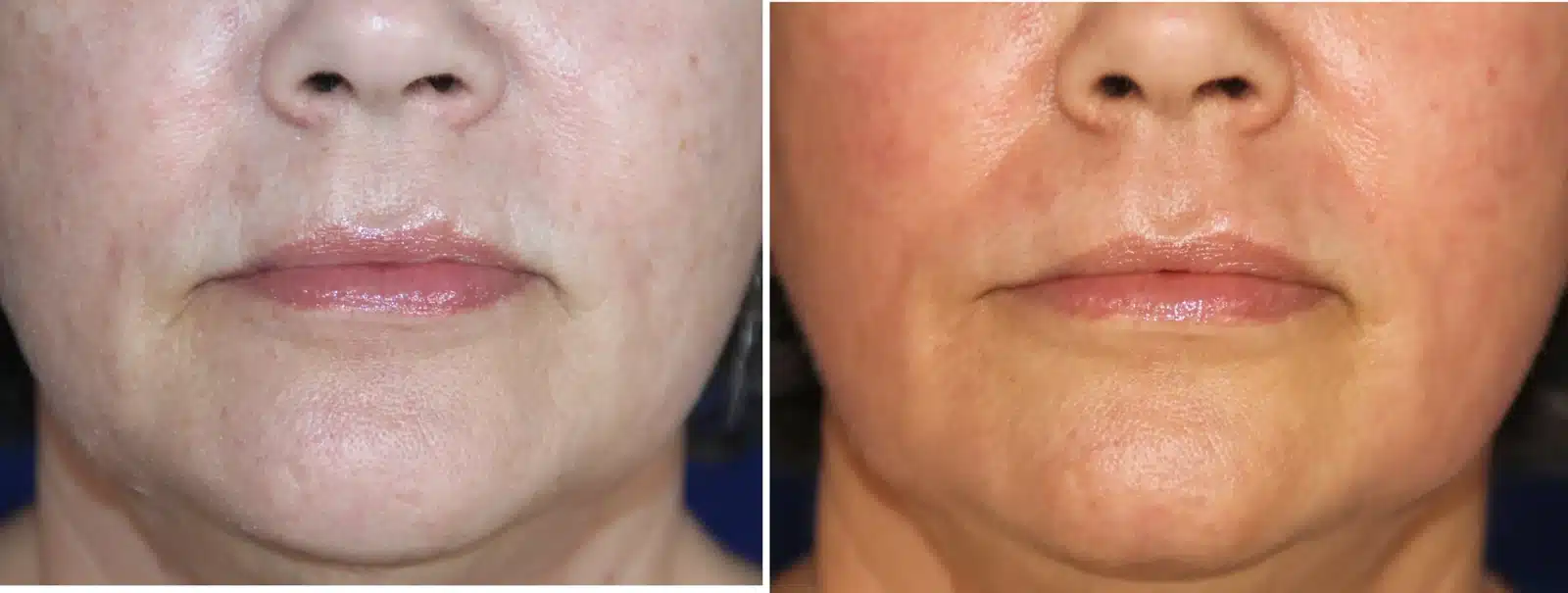 Lip filler before & after &mdash; Patient 9