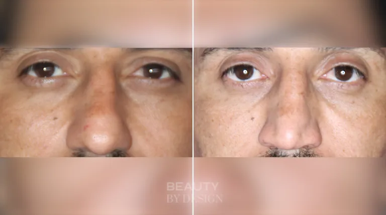 Before and after male rhinoplasty front-view photographs by Dr. Troell showing a straighter nasal bridge and improved nasal symmetry