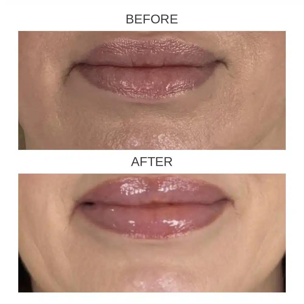 Lip filler before and after &mdash; close-up of lip volume, female patient, Dr. Troell