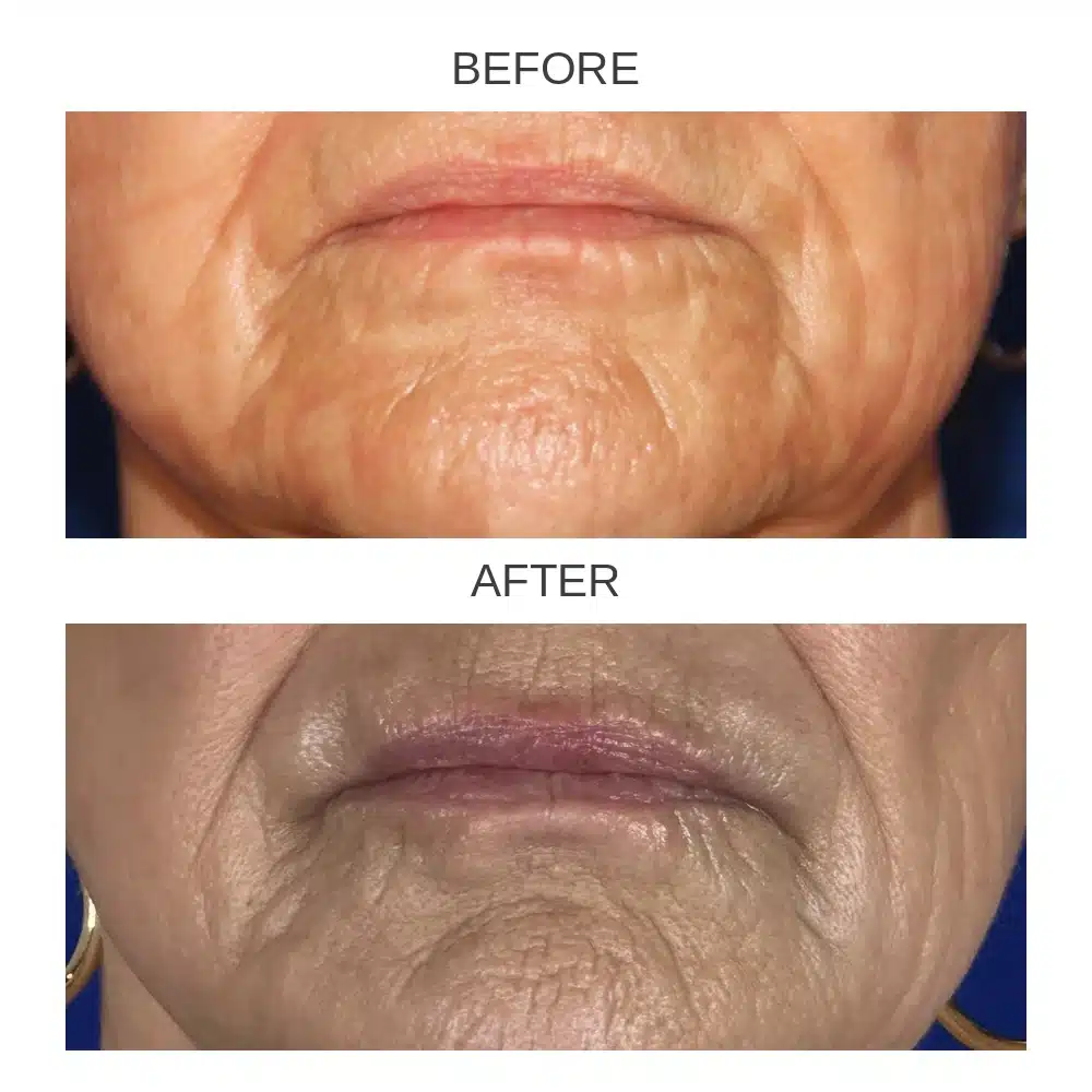Lip filler before and after &mdash; front view, female patient, Dr. Troell