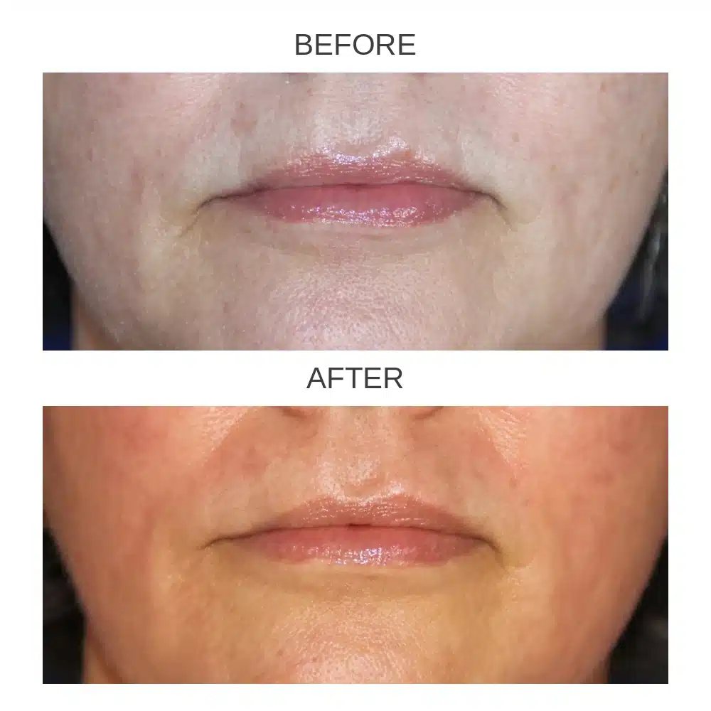 Lip filler before and after &mdash; lower face, female patient, Dr. Troell