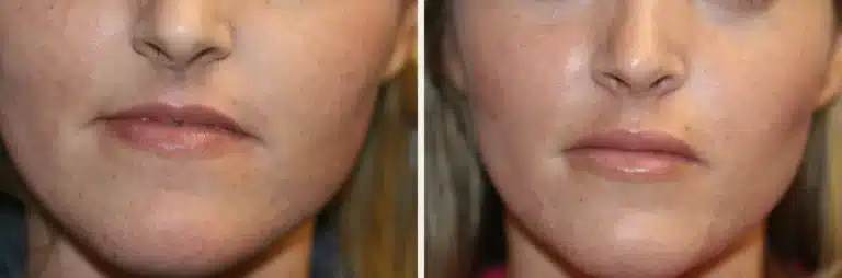 Permanent Lip Implants: An Honest Guide to Custom Silicone Lip Augmentation